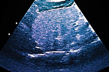 Ultrasound scan of fatty liver: recognised as the leading cause of liver dysfunction in affluent societies (Photograph: SPL)