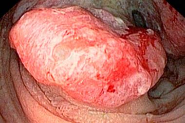 Colon cancer: endoscopic view of a malignant polyp in a patient's colon 