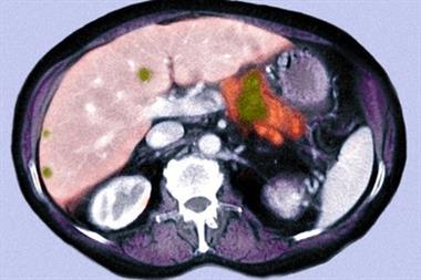 Coloured axial CT scan showing cancer (green dots) in the pancreas and liver (Photograph: SPL)