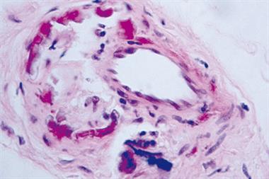 Histology of vascular calcification in CKD (Photograph: Author image)