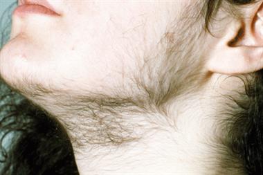 Hirsutism is more common in dark-haired women (Photograph: SPL)