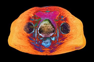 MRI scan of a 65-year-old patient with prostate cancer (Photograph: ZEPHYR/SCIENCE PHOTO LIBRARY)