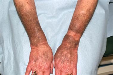 Marked blue/grey discoloration of light-exposed areas of forearms