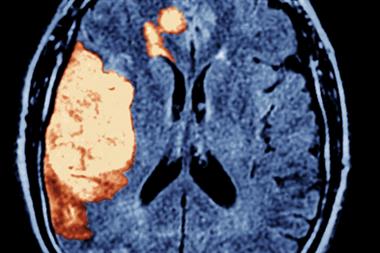 The mainstays of treatment after ischaemic stroke is aspirin or heparin (Photograph: SPL)