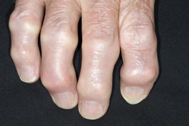 Hand OA has a good diagnosis, although swelling might be permanent