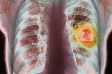 X-ray: GPs need better access to scans to help diagnose lung cancer (photo: SPL)