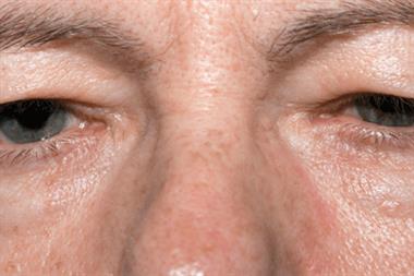 Case Study - An unusual case of unequal pupils