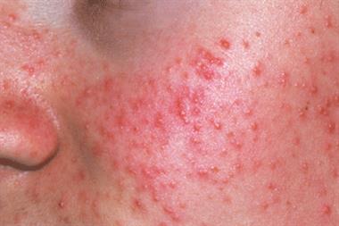 Severe acne was shown to be associated with increased suicide risk (Photograph: SPL)