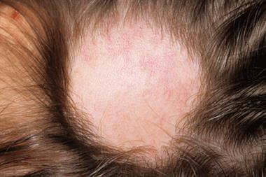 Alopecia areata: the patch of scalp is smooth centrally, and normal follicular orifices can be seen (Photograph: SPL)