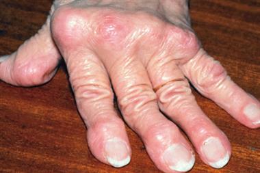 Deformity due to rheumatoid arthritis. Heberden's nodes visible (Photograph: SPL)
