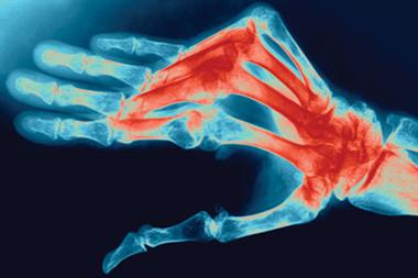 Rheumatoid arthritis: smoking has been shown to increase the risk of developing the condition (Photograph: SPL)