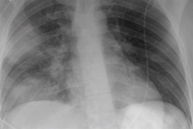 Chest X-ray of a patient with CAP showing patchy right-sided airspace changes (Photograph: Author image)