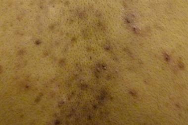 Acne most commonly affects the back, face and chest (Photograph: Dr Anneke Kai and Dr Sandeep Cliff)
