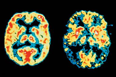 Scan of a normal patient (left) and AD patient (right). Blue/black areas show reduced brain activity (Photograph: SPL)