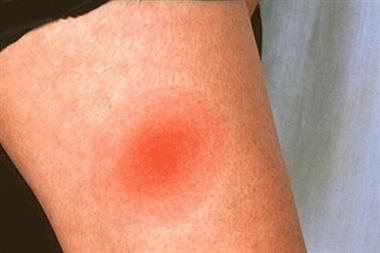 Following a bite, patients may develop a ‘bullseye’ rash (Photograph: SPL)