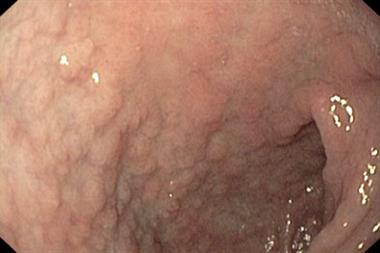 Biopsy via endoscope confirms the diagnosis of coeliac disease