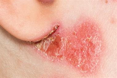 Facial psoriasis is more common in children than in adults (Photograph: SPL)