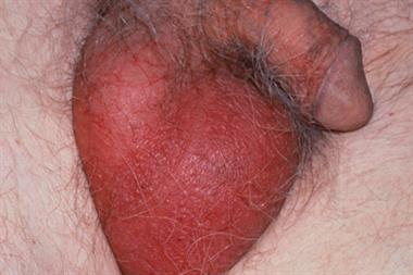 A study showed that only 3 per cent of men with epididymo-orchitis were tested for chlamydia (Photograph: SPL)