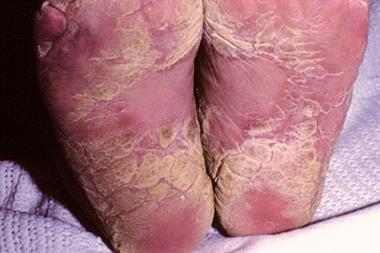 Keratoderma can present as thickening of the skin on the soles 