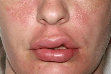Angioedema is defined as submucosal swelling and can affect the face