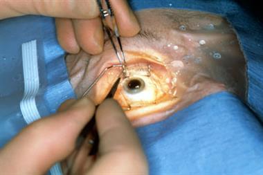 Cataract surgery: hit by PCT rationing (photo:SPL)