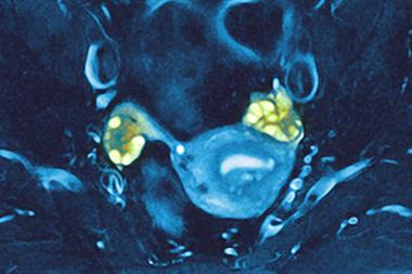 Polycystic ovary syndrome: consider in girls of normal height with secondary amenorrhoea