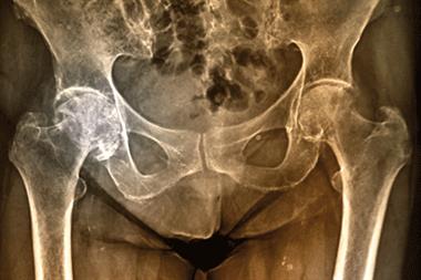 There are more than 300,000 fragility fractures a year in the UK, and hip fractures alone cost £2 billion (Photograph: SPL)