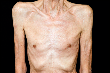 Unintended weight loss - red flag symptoms
