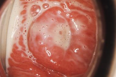 Abnormal vaginal discharge - red flag symptoms