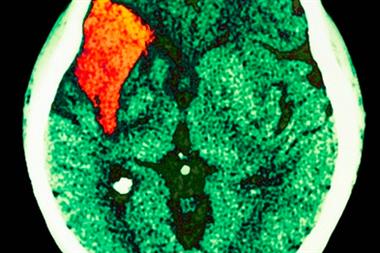 A brain CT scan demonstrating stroke