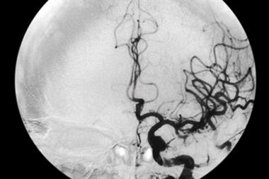 Carotid angiogram of a stroke patient: the use of IV thrombolysis carries a risk of haemorrhage (Photograph: SPL)