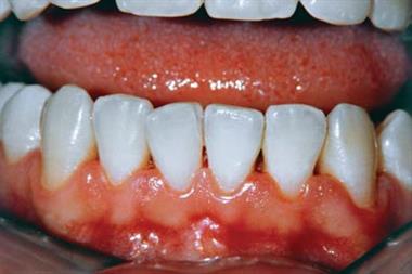 Inflamed gums may indicate a serious underlying disorder (Photograph: SPL)
