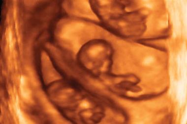 3D ultrasound scan showing triplets (Photograph: SPL)