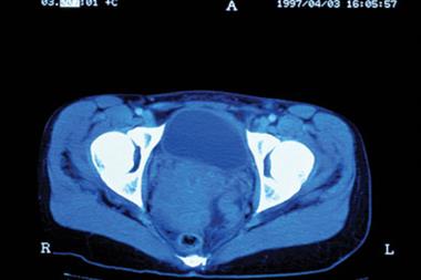 CT scan of cervical cancer (Photograph: SPL)