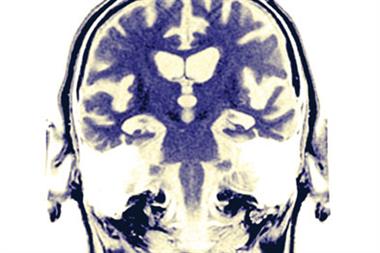 Alzheimer's risk was linked to the self-rating of health (Photograph: SPL)