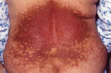 Burn on a patient's back caused by a hot water bottle (Photograph: SPL)
