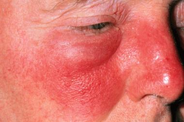 Erysipelas frequently presents on the face. The infection is often caused by Streptococcus pyogenes (Photograph: SPL)