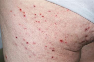 Dermatitis herpetiformis: autoimmune disease (Photograph: Author image)