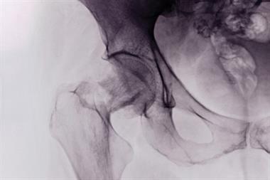 Fractures can result in mortality, morbidity and loss of independence (Photograph: SPL)