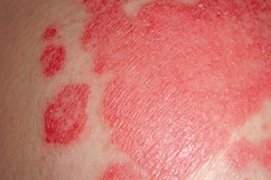 Approximately 2% of the UK population is affected by psoriasis (Photograph: SPL)