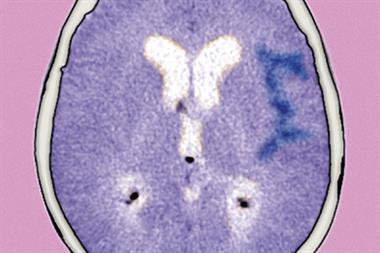 Subarachnoid haemorrhage, as shown on CT scan, may present with thunderclap headache