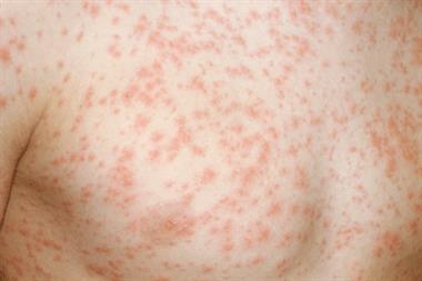 GPs should disclose details about notifiable diseases, such as measles (Photograph: SPL)