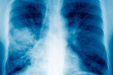Pneumonia acquired in the community may be due to H influenzae (Photograph: SPL)