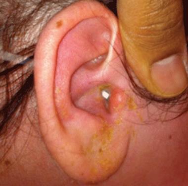 Grade III of the Brighton Grading Scheme for severity of acute otitis externa includes tympanic membrane obscured by oedematous ear canal (Author images)