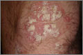 Typical plaques of psoriasis vulgaris on the knee showing silvery scale on salmon pink background (Photograph: Dr Anshoo Sahota, Dr Alvin Lee)