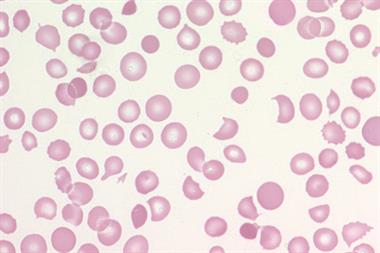 Microangiopathic haemolytic anaemia with red cell fragments and irregularly shaped red blood cells (Image: David Roberts and John Burthem)