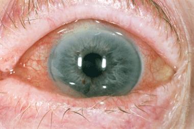 Symptoms of acute anterior uveitis include pain, bloodshot sclera (as shown) and reduced vision (Photograph: SPL)