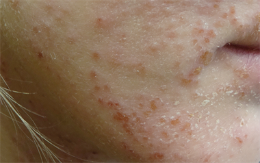 Eczema herpeticum is a dermatological emergency (Photograph: Dr Ekaterina Burova)