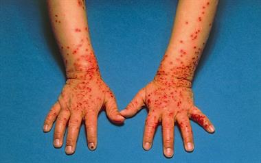 Eczema herpeticum: small, very even, punched-out blisters
