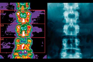 Vitamin D supplementation had a small effect on lumbar spine BMD (blue/purple: least dense areas) (Photograph: SPL)
